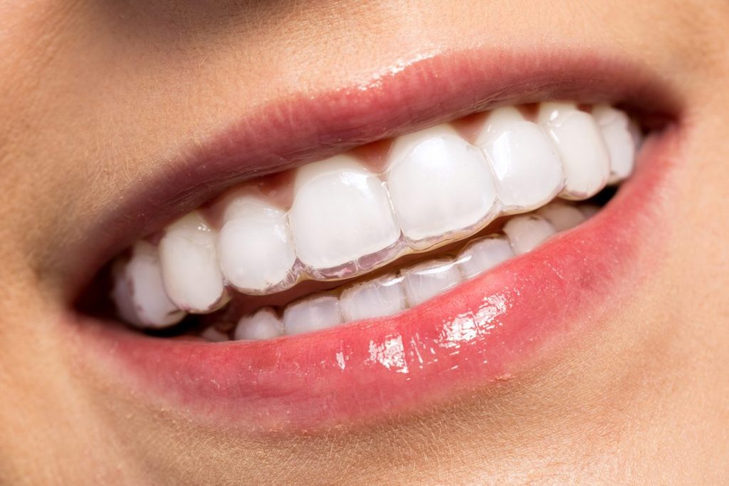 Invisalign En Lima Perú | Ortodoncia Invisible | Ortodoncia Sin Brackets